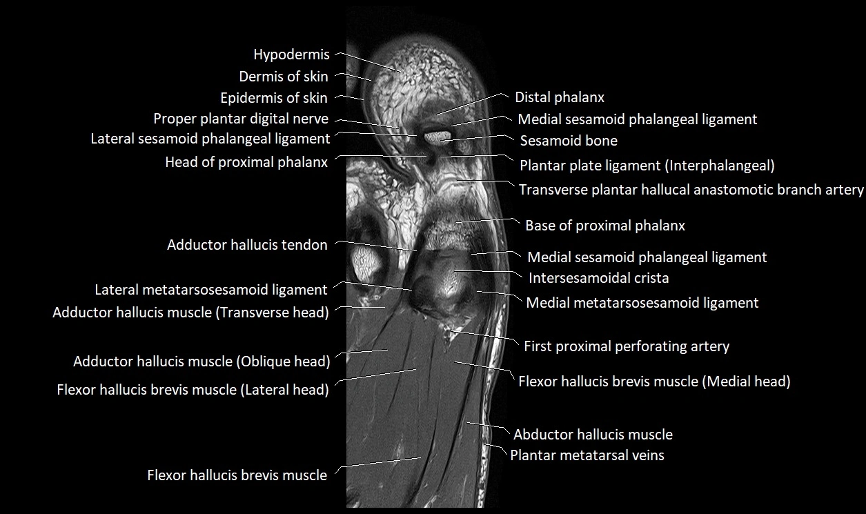 Great Toe micro anatomy MRI axial cross sectional 3T image 19.webp
